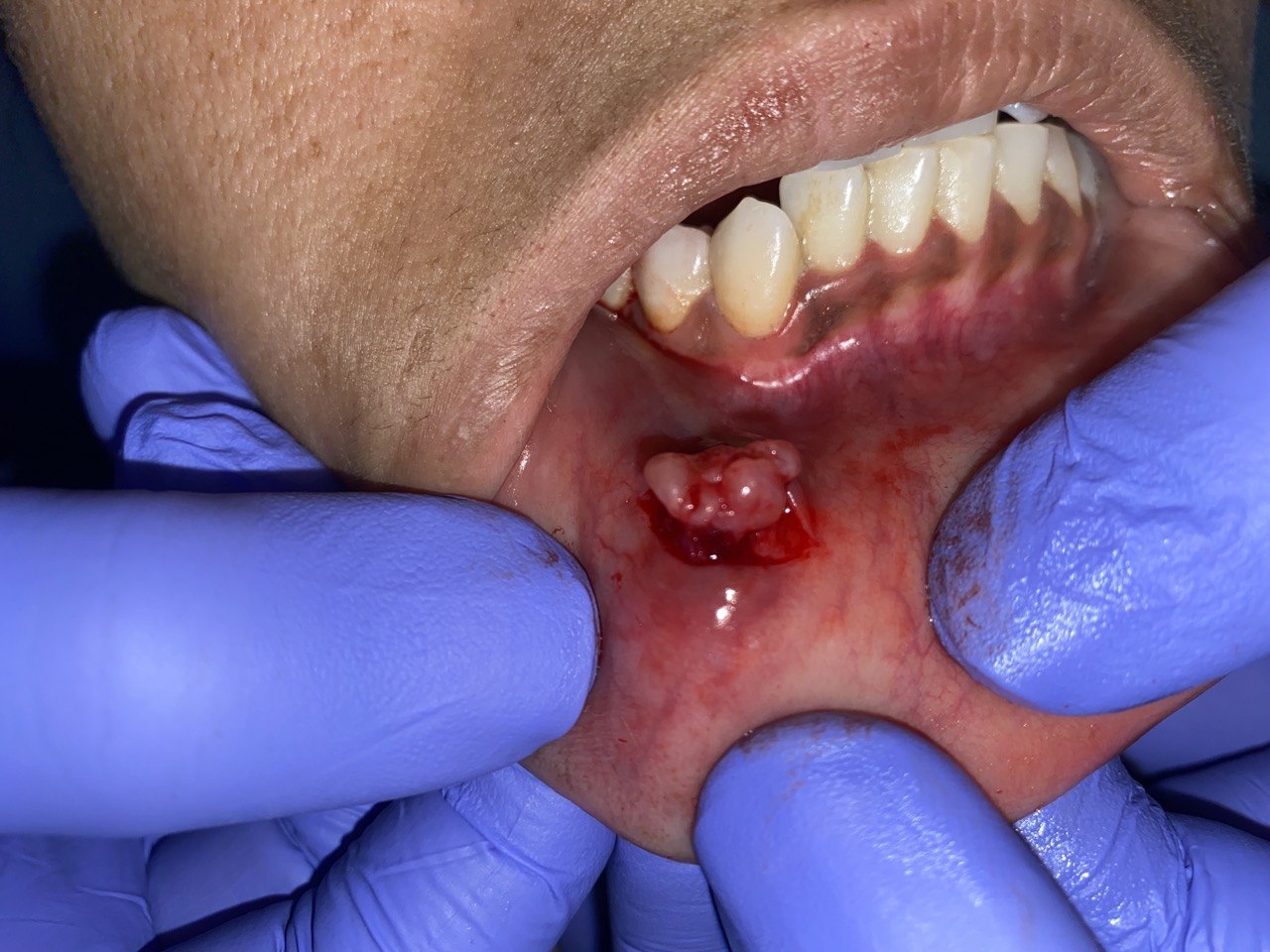 Neuroma case — treatment approach